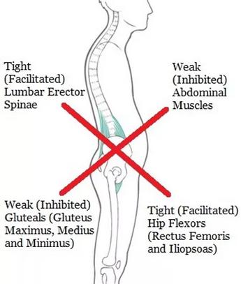 Lower Crossed Syndrome 